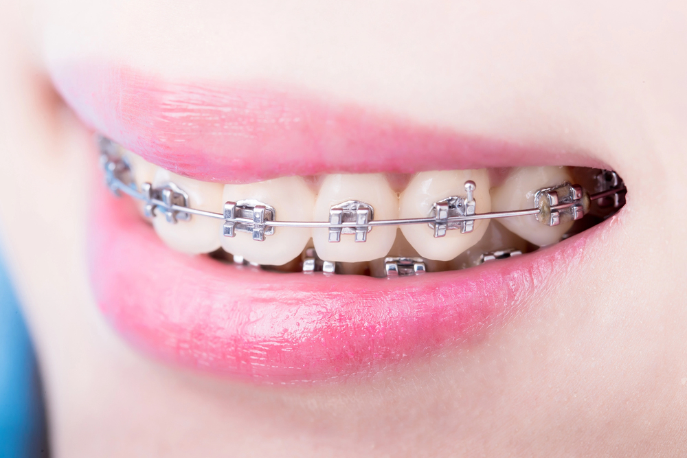 Orthodontics in Riverview