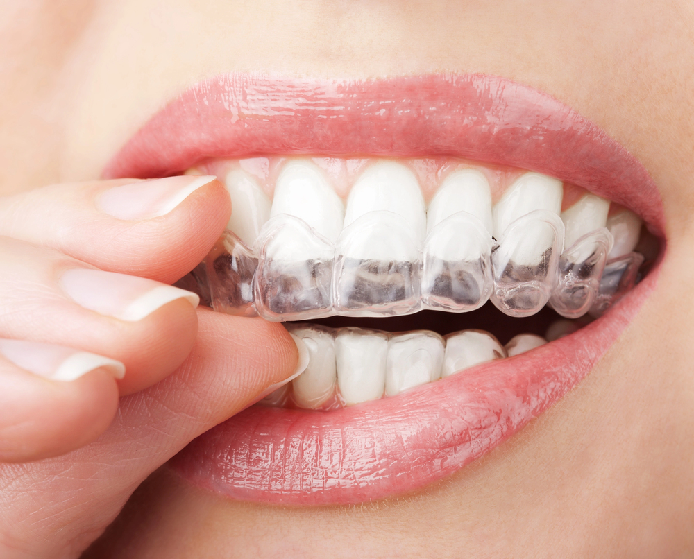 Clear Aligners in Riverview