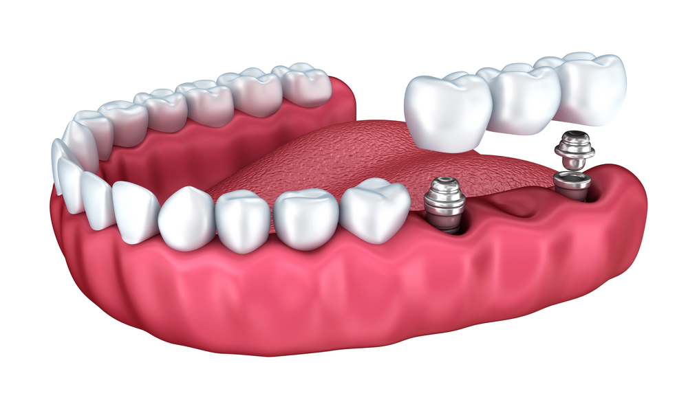 Implant-Supported Dentures